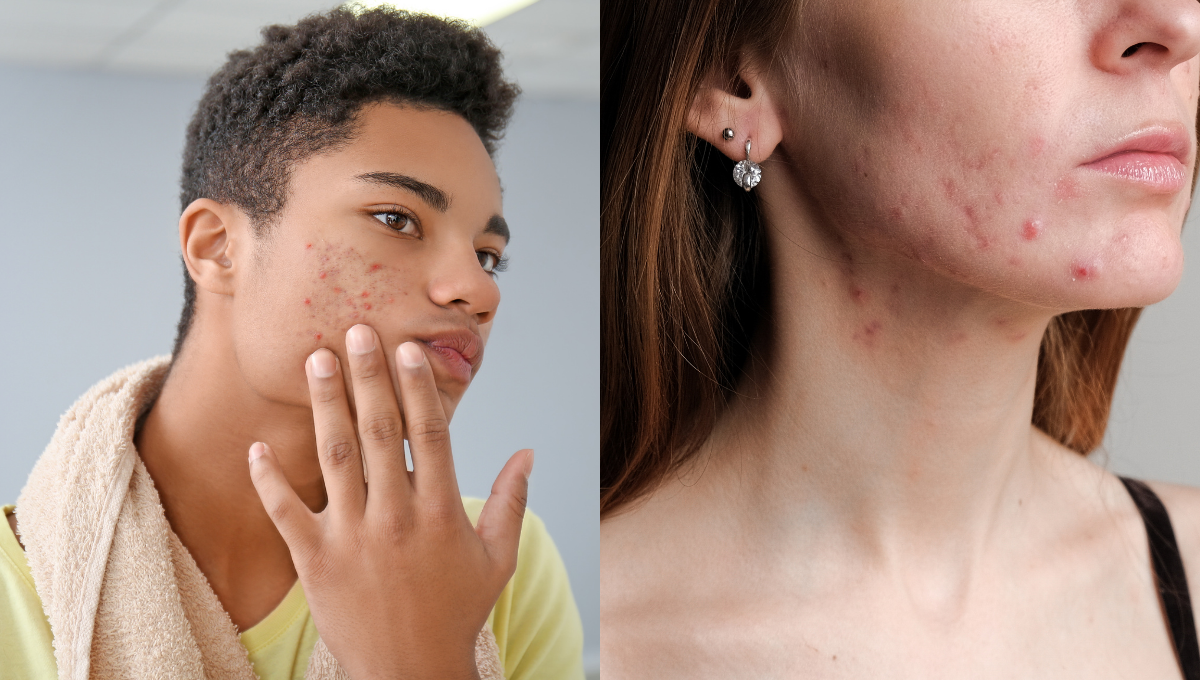 Acne.. adult vs teenage and how to tackle it