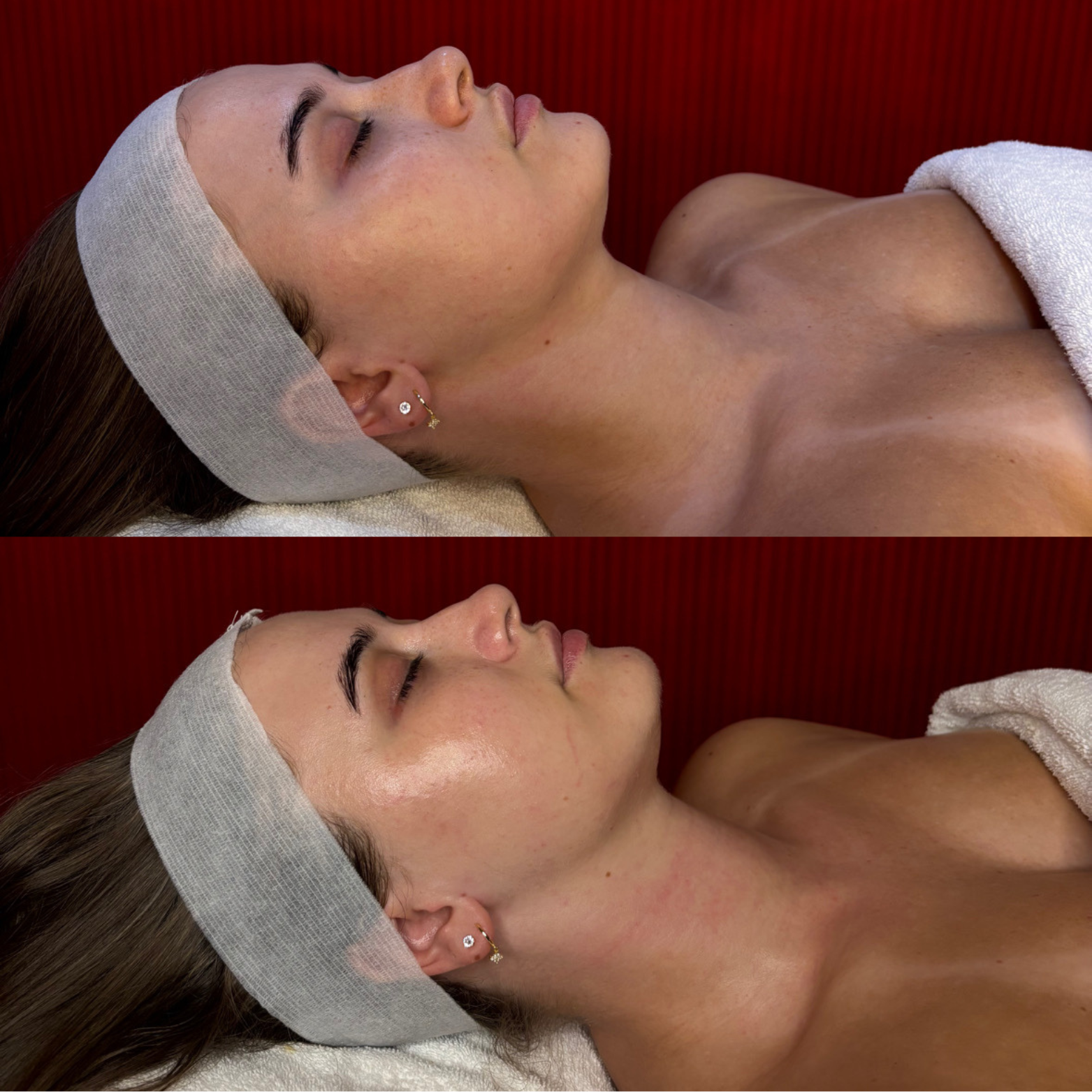 Lymphatic Lift
