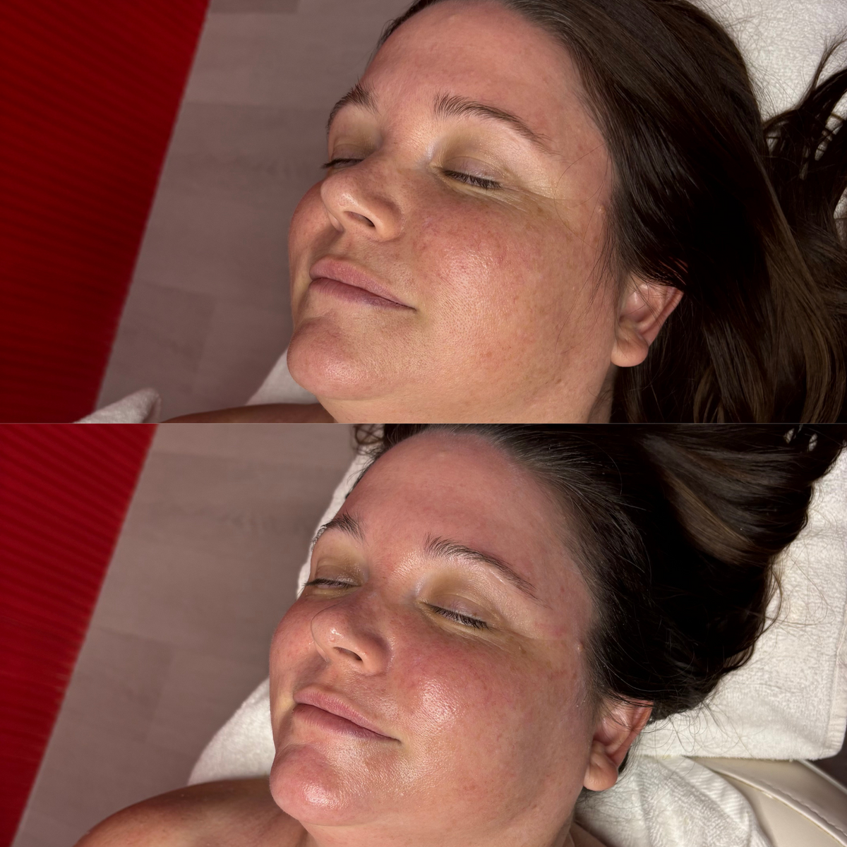 Lymphatic Lift Before and After