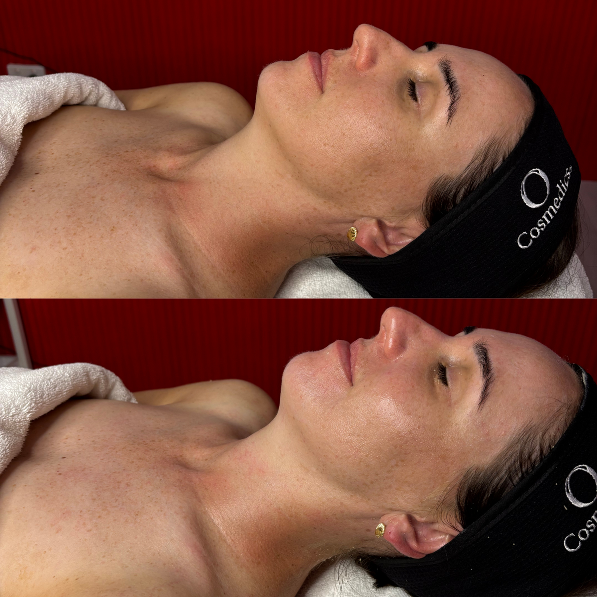 Lymphatic Lift Before and After